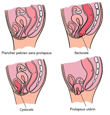 prolapsus génital